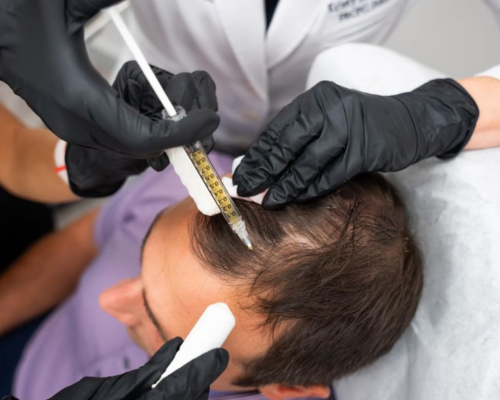 PRP for Alopecia Mysore